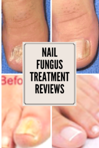 nail fungus before and after photos