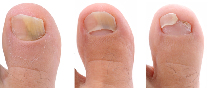 Hydrogen Peroxide And Vinegar For Toe Nail Fungus