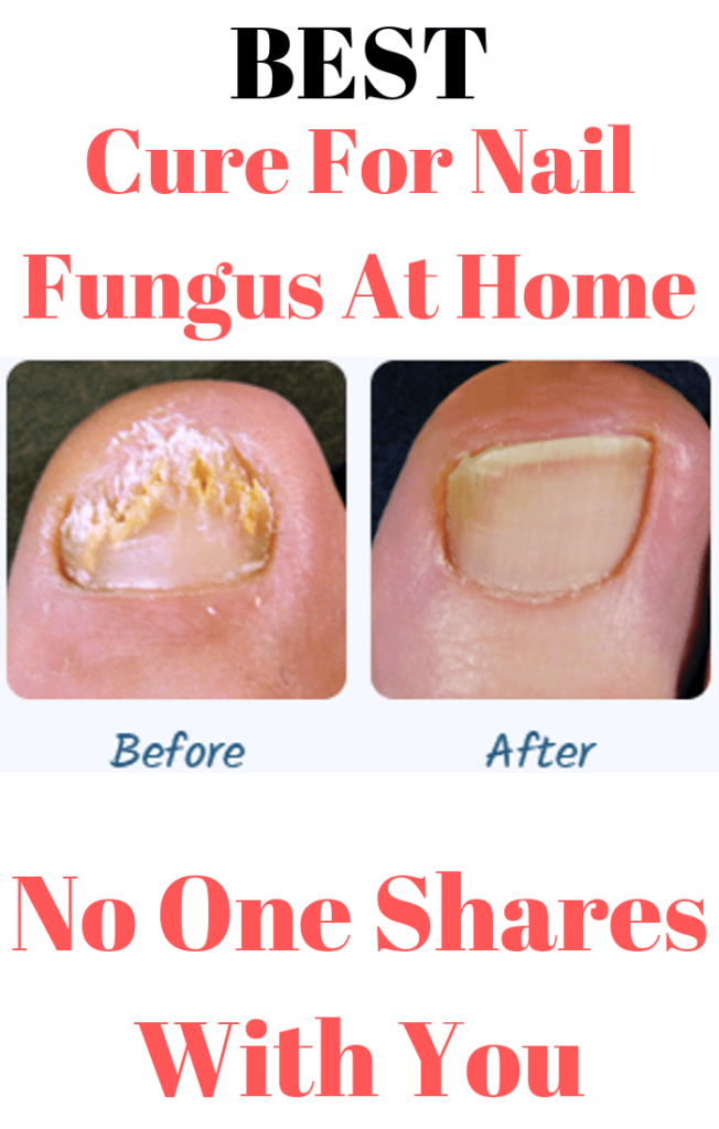 Cure-For-Nail-Fungus-At-Home