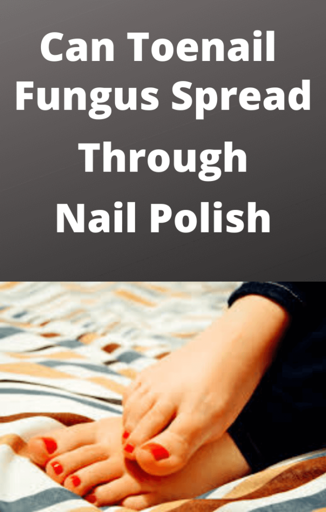 Can Toenail Fungus Spread Through Nail Polish