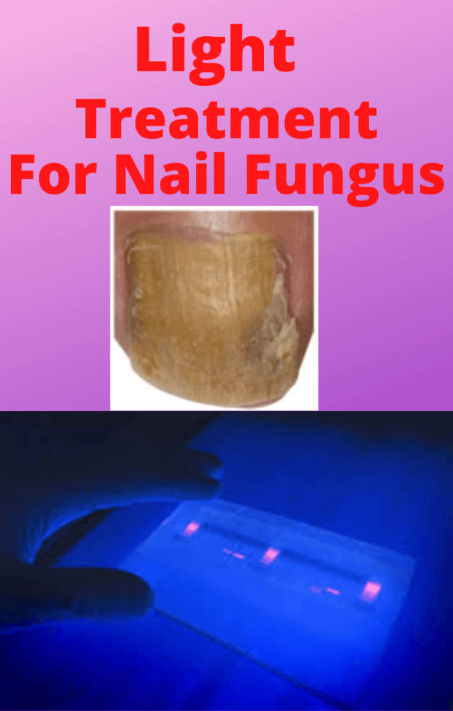 Light Treatment For Nail Fungus