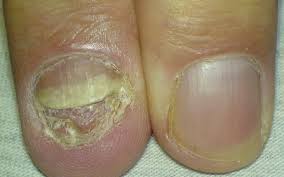 Photos Of Fingernail Fungus Severe