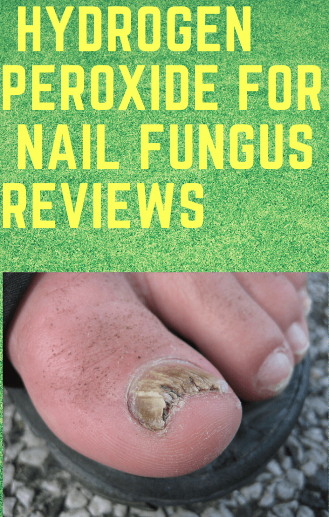 Hydrogen peroxide for nail fungus reviews