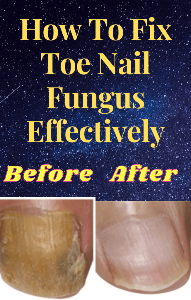how to fix toe nail fungus