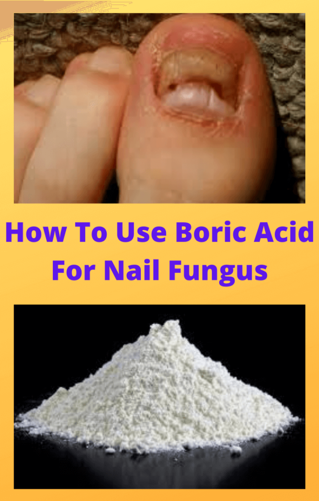 Boric-Acid-For-Nail-Fungus