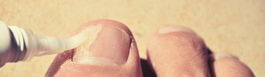 Miconazole Nitrate For Nail Fungus