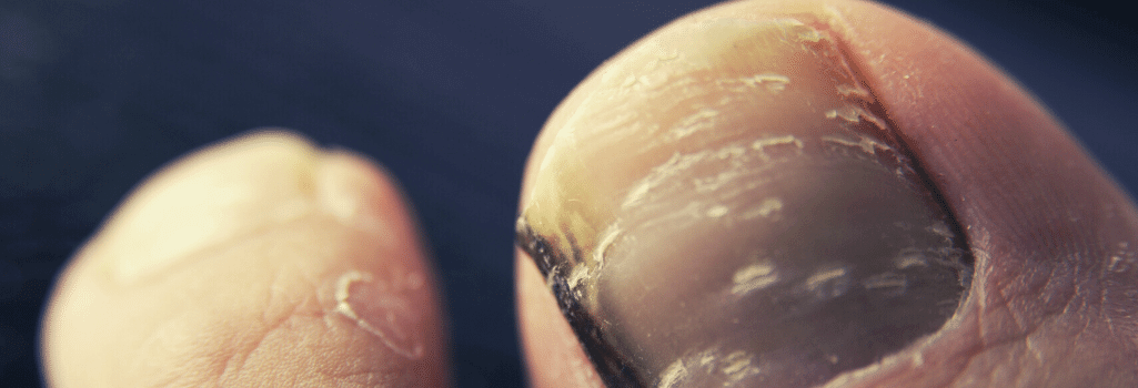 Does Healthpoint Fungal Nail Treatment Work
